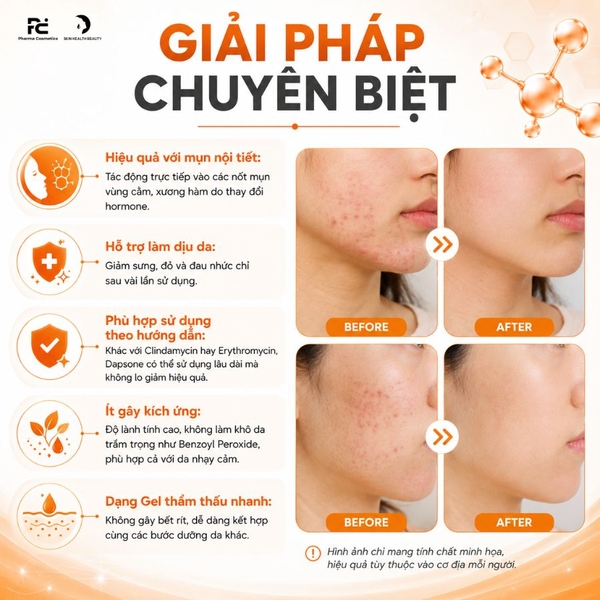 Klenadap 7.5% Dapsone – Gel Trị Mụn Giải Pháp Vàng Cho Mụn Nội Tiết Và Mụn Viêm