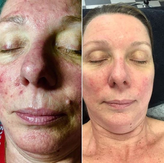 SIGNATURE FACELIFT®: Phục Hồi Làn Da Nhạy Cảm, Mụn Viêm, Da Khô, Mất Nước Giãn Mao Mạch