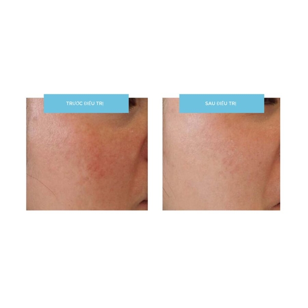 Md:cocktail TranexWhite – Ampoule Đặc Trị Nám Mảng & Trẻ Hóa Da Đa Tầng