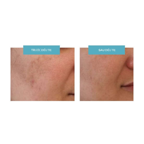 ​​​Md:Tranex Retipeel Whitening Cream – Kem Trị Nám Chuyên Sâu & Trẻ Hóa Da Đa Năng