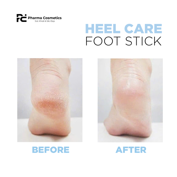 HEEL CARE FOOT STICK / THANH LĂN DẠNG THỎI CHĂM SÓC GÓT CHÂN, GIÚP LÀM MỀM VÀ GIẢM NỨT NẺ GÓT CHÂN