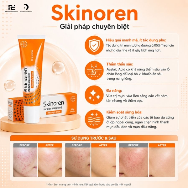 Skinoren Acidum Azelaicum: Kem Trị Mụn, Mờ Thâm & Điều Trị Rosacea Chuyên Sâu