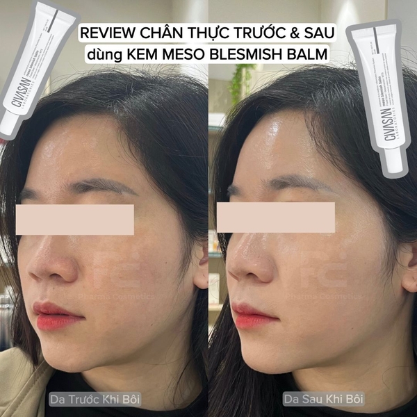 Civasan Meso Blemish Balm 35ml – Kem Dưỡng Tái Tạo & Bảo Vệ Da Sau Liệu Trình