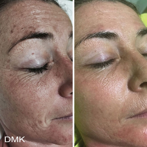 LIỆU PHÁP ENZYME THERAPY: Phục Hồi Làn Da "Không Dung Nạp Điều Trị