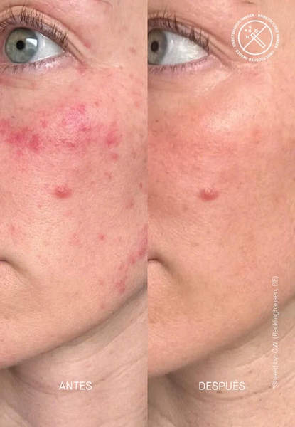 THERAMID CERAMIDE TREATMENT / TINH CHẤT PHỤC HỒI HÀNG RÀO BẢO VỆ DA