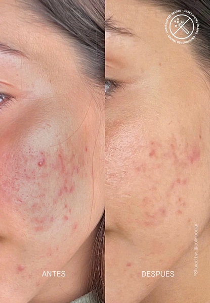 THERAMID AZID / TINH CHẤT TRỊ MỤN VÀ CHỐNG LÃO HÓA ( THUẦN CHAY)