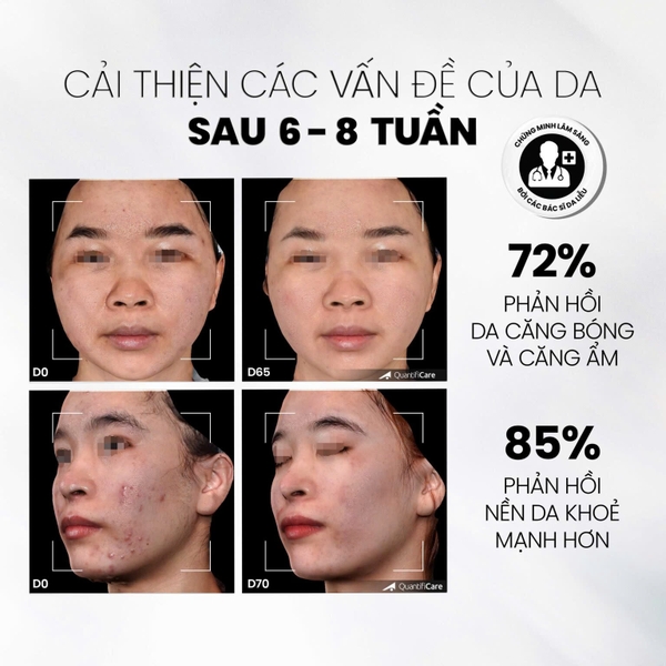 MDCARE GLOW EXFO / TẨY TẾ BÀO CHẾT LÀM SÁNG, MỜ THÂM VÀ ĐỀU MÀU DA 