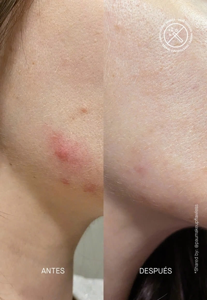 ACNEMY POSTZIT® POST BREAKOUT TREATMENT / HUYẾT THANH GIẢM THÂM & NGĂN NGỪA MỤN TRỞ LẠI 