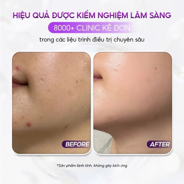 VQM Phytocin V2 : Kem Dưỡng Ẩm & Phục Hồi Da Chuyên Sâu, Cải Thiện Mụn & Kích Ứng