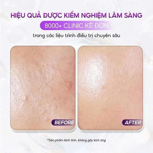 VQM Phytocin V2 : Kem Dưỡng Ẩm & Phục Hồi Da Chuyên Sâu, Cải Thiện Mụn & Kích Ứng