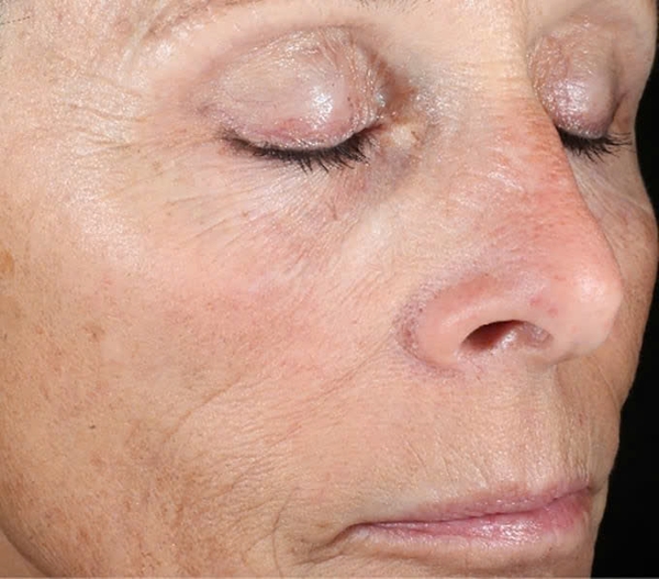IS CLINICAL ACTIVE PEEL SYSTEM: Bộ Đôi Tái Tạo Da Chuyên Sâu, Cho Làn Da Căng Bóng & Mịn Màng