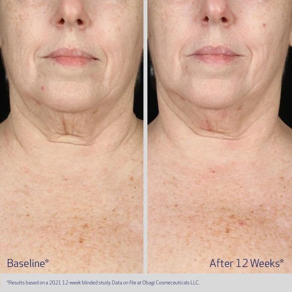 Obagi Elastiderm Neck And Décolleté Concentrate / Tinh Chất Dưỡng Da Vùng Cổ