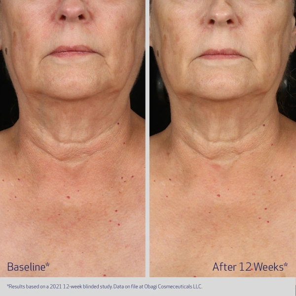 Obagi Elastiderm Neck And Décolleté Concentrate / Tinh Chất Dưỡng Da Vùng Cổ