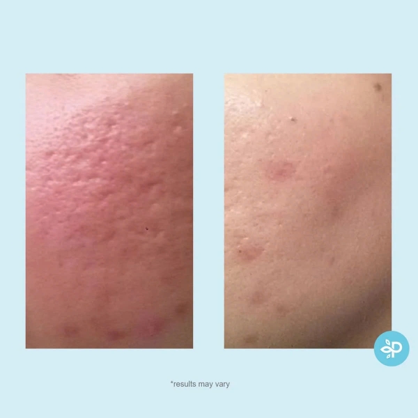 PERFECT IMAGE Lactic 50% Gel Peel: Thay Da Sinh Học Làm Sáng, Trẻ Hóa & Mờ Thâm Nám