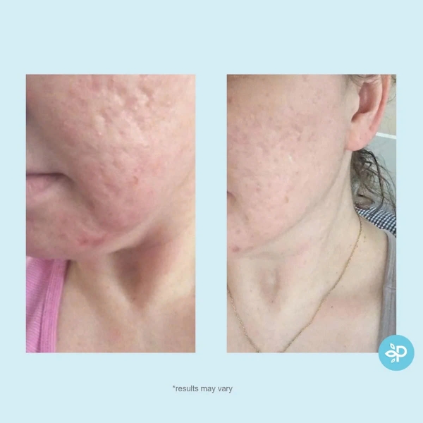 Perfect Image Glycolic 50% Gel Peel: Giải Pháp Thay Da Sinh Học Trẻ Hóa & Tái Tạo Bề Mặt Chuyên Sâu