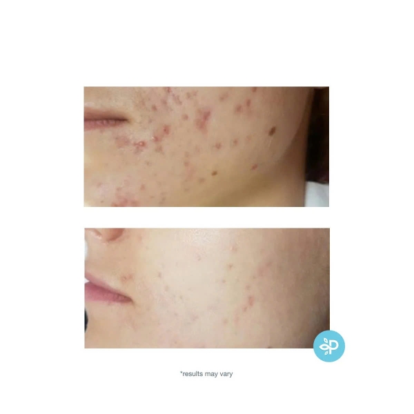 PERFECT IMAGE TCA 15% Skin Peel: Giải Pháp Peel Da Độ Sâu Trung Bình – Hỗ Trợ Điều Trị Sẹo Mụn, Nếp Nhăn Sâu & Nám Tình Trạng Nặng