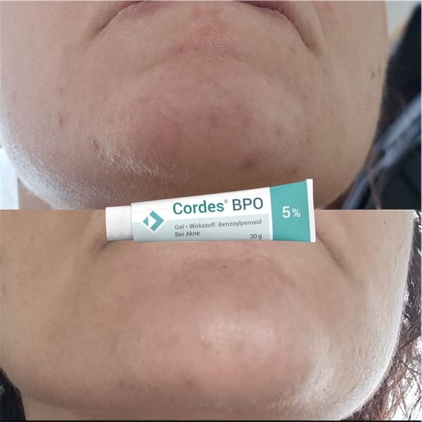 Cordes® BPO 5% Gel – Giải Pháp Giảm Mụn Trứng Cá Cấp Độ Trung Bình