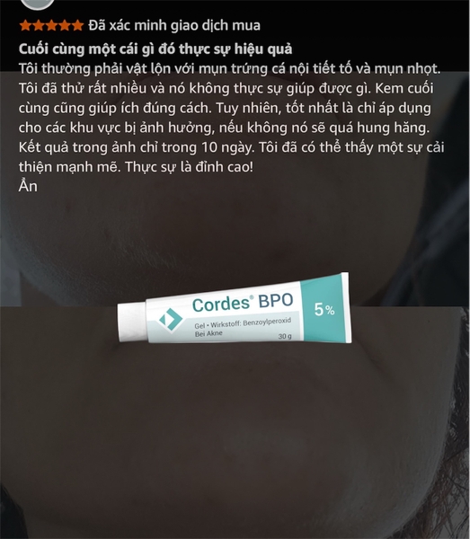 Cordes® BPO 5% Gel – Giải Pháp Giảm Mụn Trứng Cá Cấp Độ Trung Bình