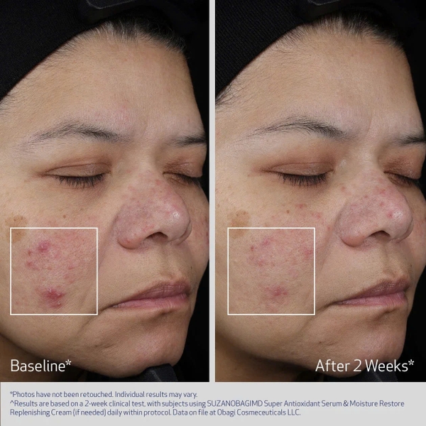 Obagi SUZANOBAGIMD® Super Antioxidant Serum – Siêu Tinh Chất Chống Oxy Hóa & Trẻ Hóa Cho Da Nhạy Cảm