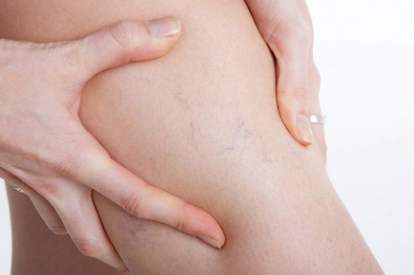 Cách trị giãn tĩnh mạch chân tại nhà