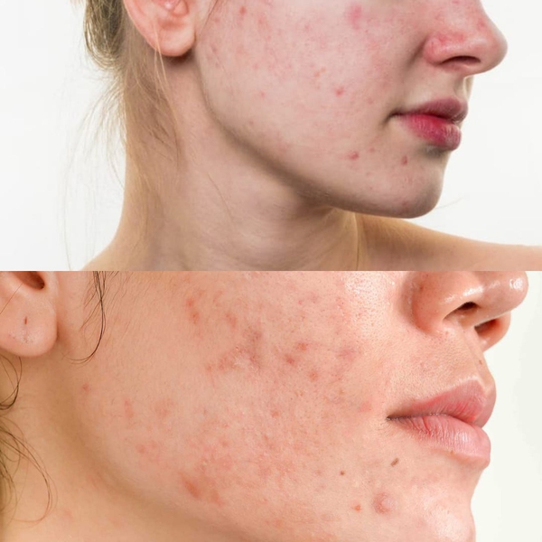 Thâm mụn và cách chăm sóc da cần biết