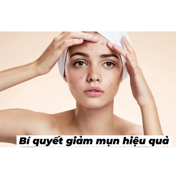 5 bí quyết giảm mụn hiệu quả