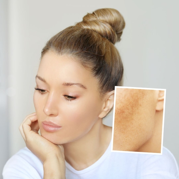 Top các hoạt chất điều trị thâm nám, tàn nhang hiệu quả