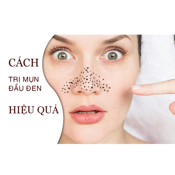 Bí quyết đánh bay mụn đầu đen ngay tại nhà