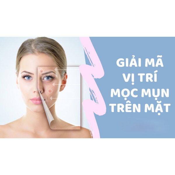 5 vị trí nổi mụn cảnh báo sức khỏe của nàng đang gặp vấn đề