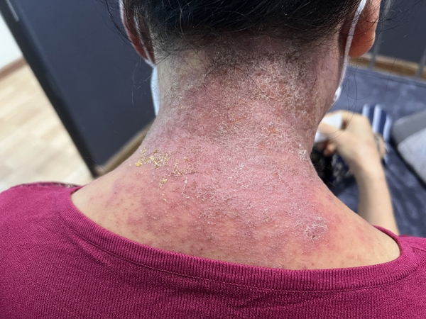 VIÊM DA DỊ ỨNG TIẾP XÚC