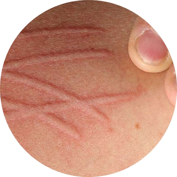 CHỨNG DA VẼ NỔI