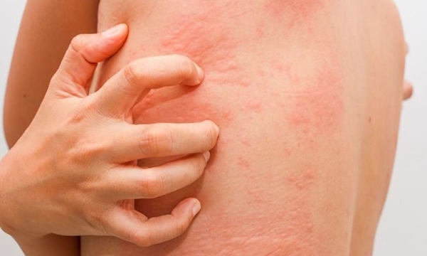 MÀY ĐAY MẠN TÍNH DO KÝ SINH TRÙNG