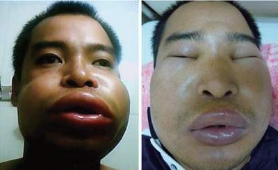 PHÙ MẠCH DI TRUYỀN - MỘT BỆNH LÝ NGUY HIỂM