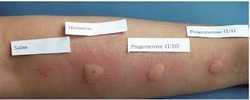 VIÊM DA DỊ ỨNG TỰ MIỄN DO PROGESTERON