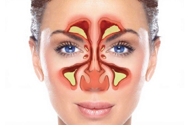 TÁC HẠI VÀ CÁCH PHÒNG TRÁNH VIÊM XOANG