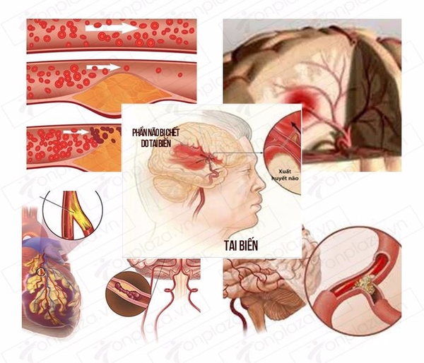 Bệnh tai biến mạch máu não