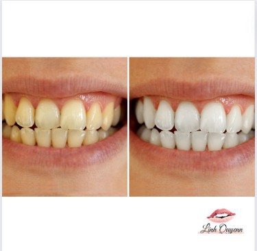 Các bước chăm sóc răng miệng hàng ngày