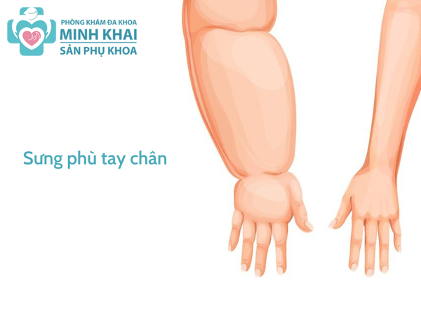 Sưng phù tay chân - cao huyết áp trong thai kỳ