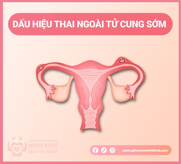 THAI NGOÀI TỬ CUNG PDF