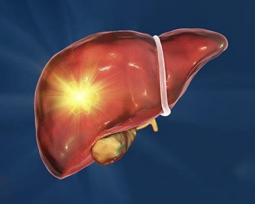 Adenoma gan là gì? Nguyên nhân và cách phòng ngừa?