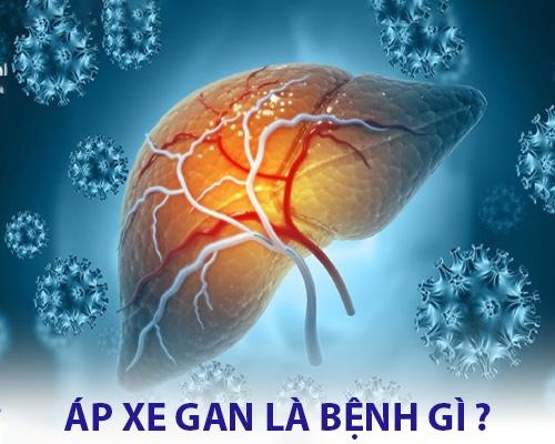 Áp xe gan là gì? Nguyên nhân, triệu chứng,cách phòng bệnh
