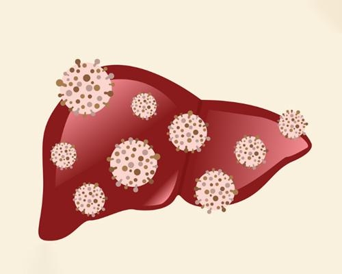 Dấu hiệu viêm gan C giai đoạn đầu là gì?