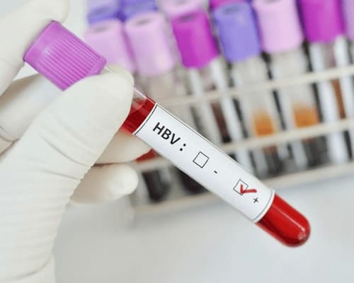 Định lượng HBV bao nhiêu là bình thường?