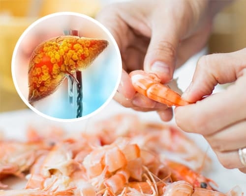 Bệnh gan nhiễm mỡ ăn tôm được không?