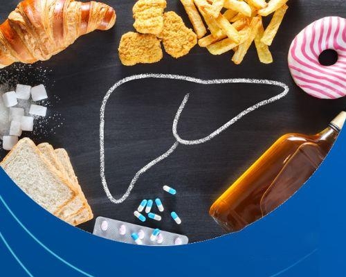 Gan nhiễm mỡ độ 2 kiêng gì? Chế độ ăn chuẩn ngừa xơ gan