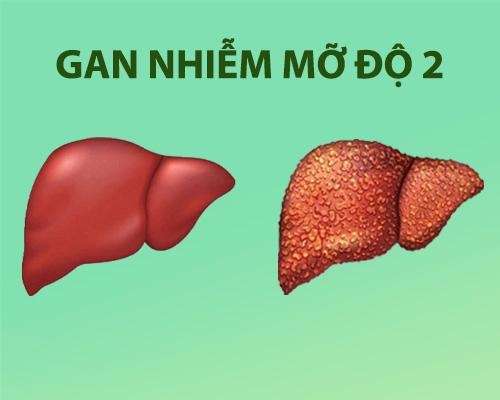 Gan nhiễm mỡ độ 2 là gì có nguy hiểm không?