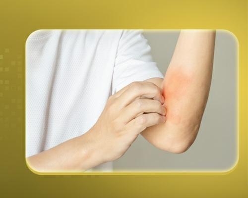 Gan nhiễm mỡ gây ngứa không? Dấu hiệu nhận biết