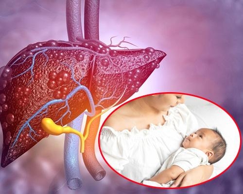 Gan nhiễm mỡ sau sinh có nguy hiểm không? Những điều mẹ cần biết
