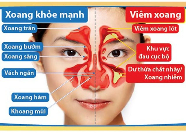 Hiểu về Bệnh Viêm Xoang: Nguyên Nhân, Triệu Chứng và Phương Pháp Điều Trị