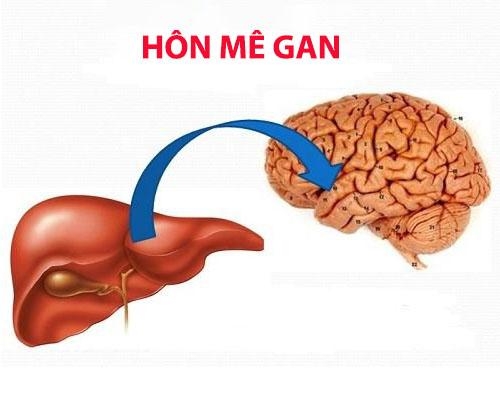 Hôn mê gan là gì? Nguyên nhân và cách phòng ngừa